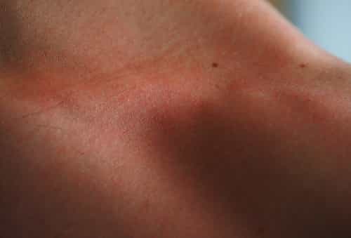 Skin irritations