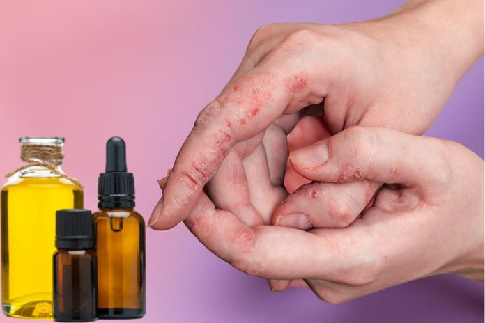 Antifungal Essential Oils