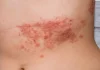 Home Remedies for Rashes Home Remedies for Rashes