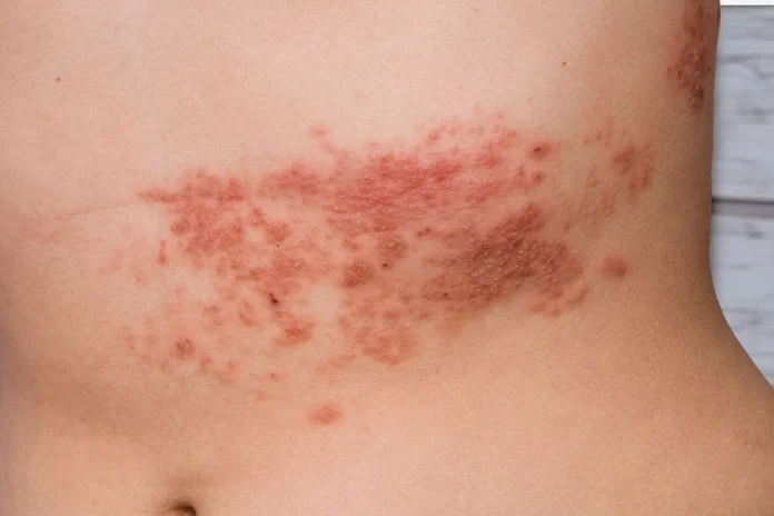 Home Remedies for Rashes